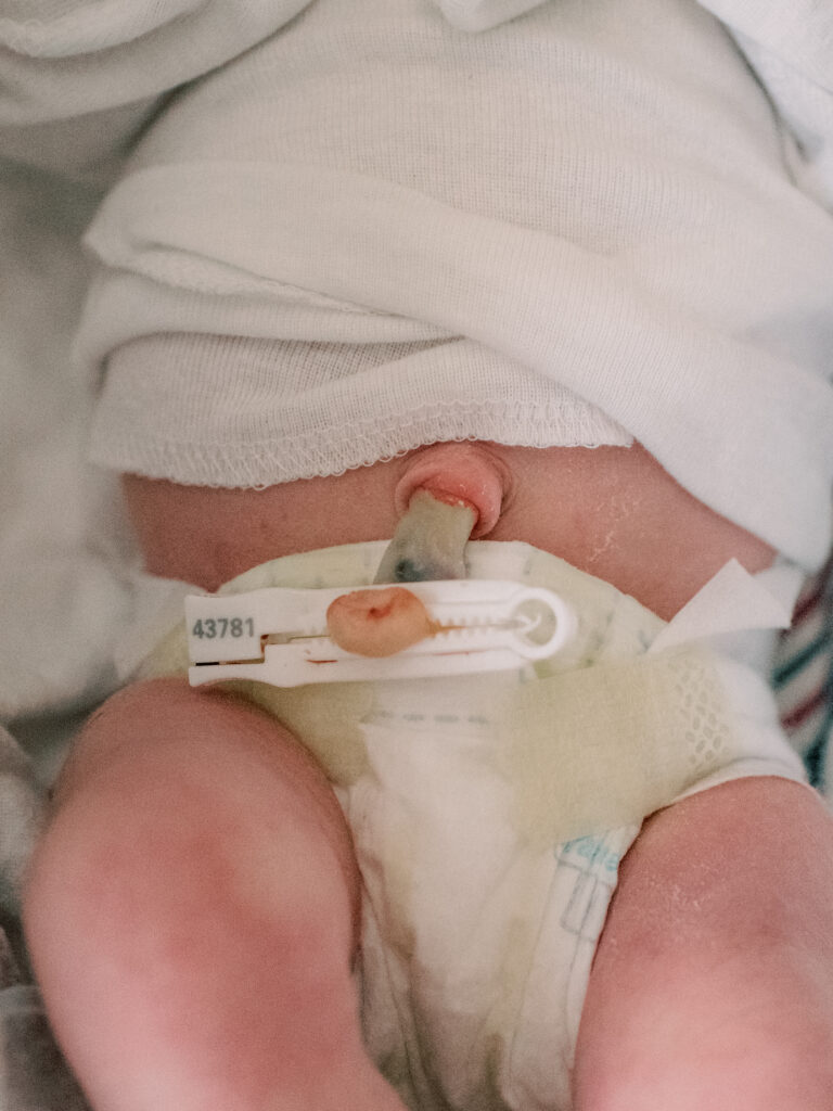 Newborn baby umbilical cord photo.